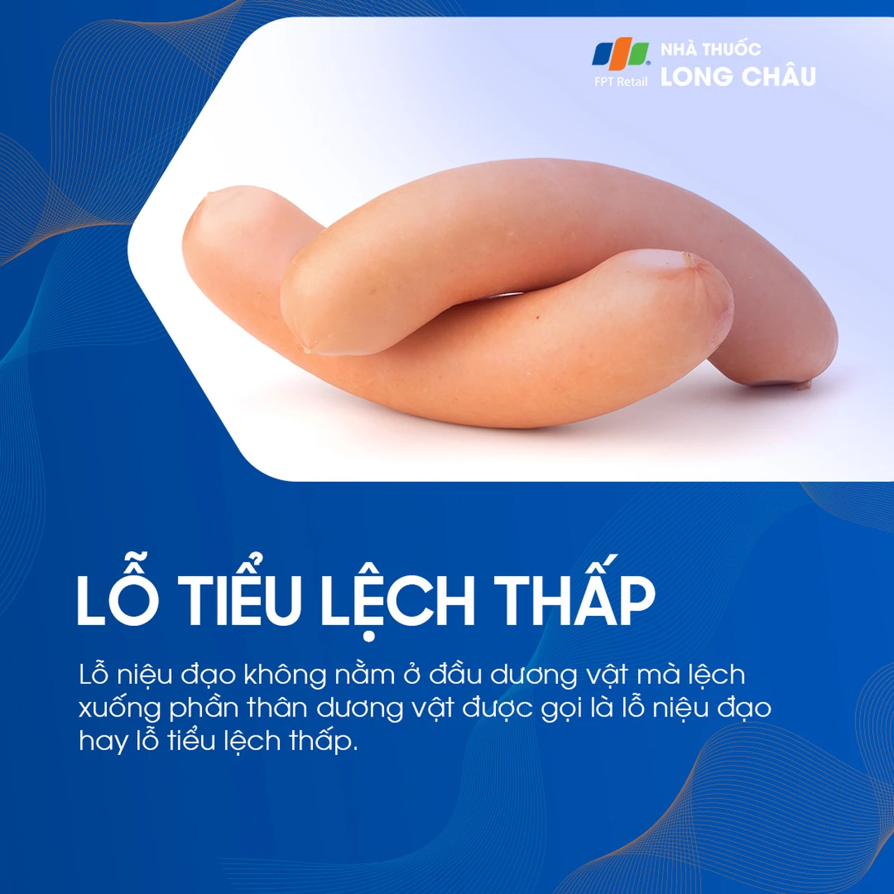 Lỗ tiểu lệch thấp 1