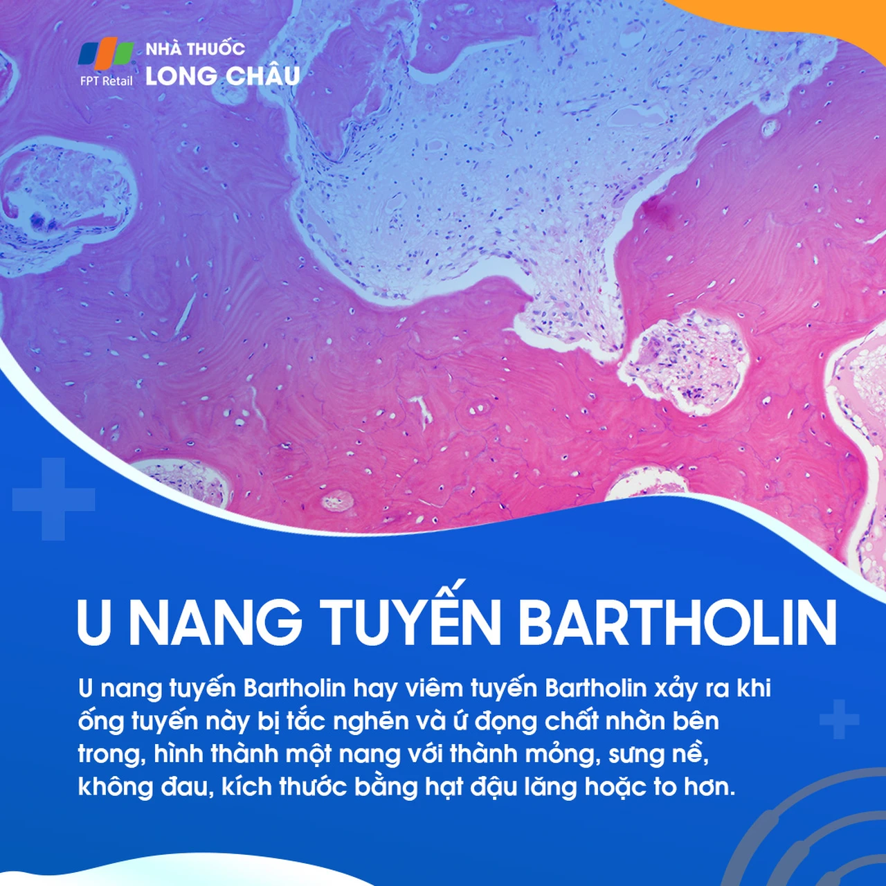 U nang tuyến Bartholin 1