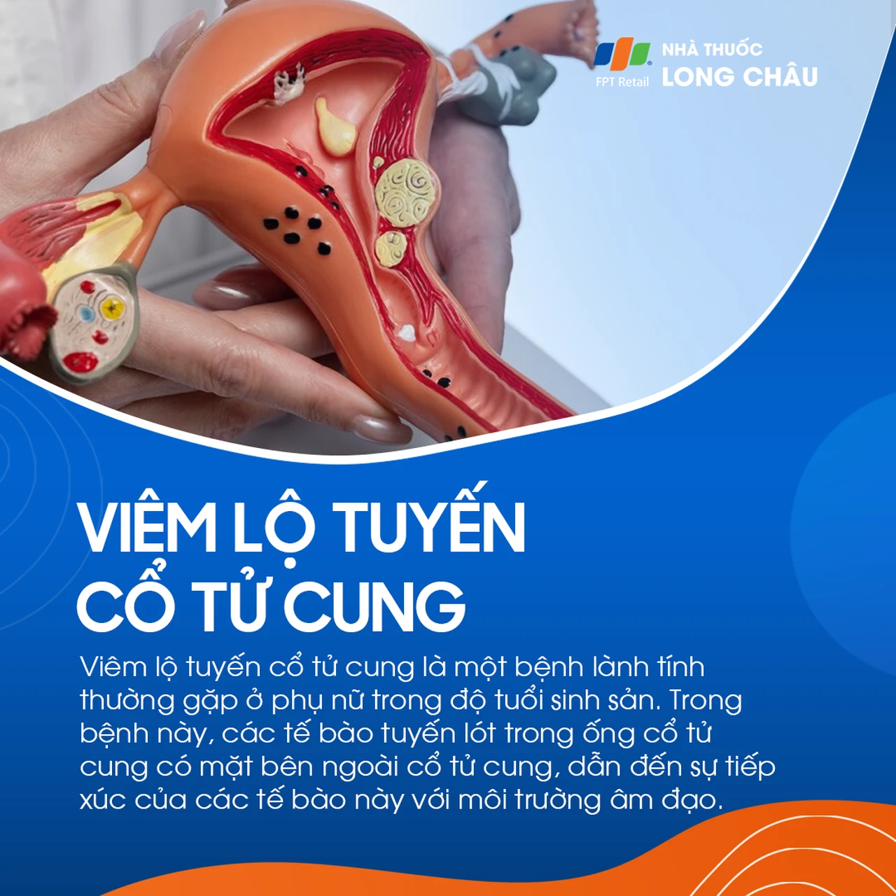 Viêm lộ tuyến cổ tử cung 1