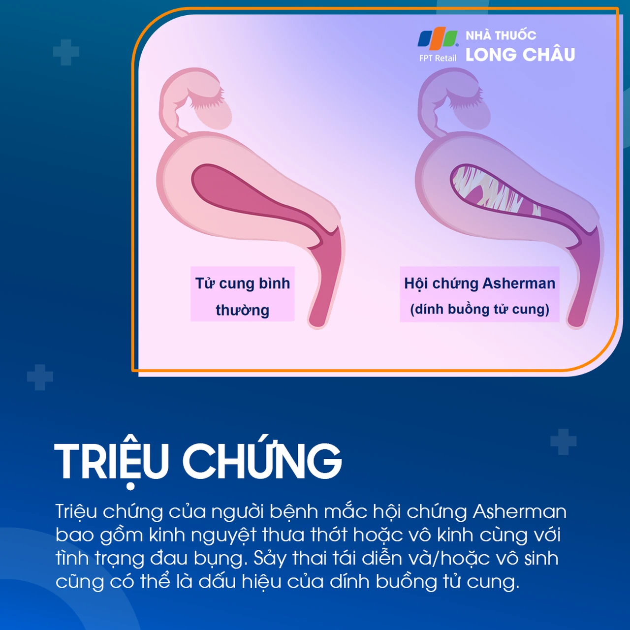 Dính buồng tử cung 2