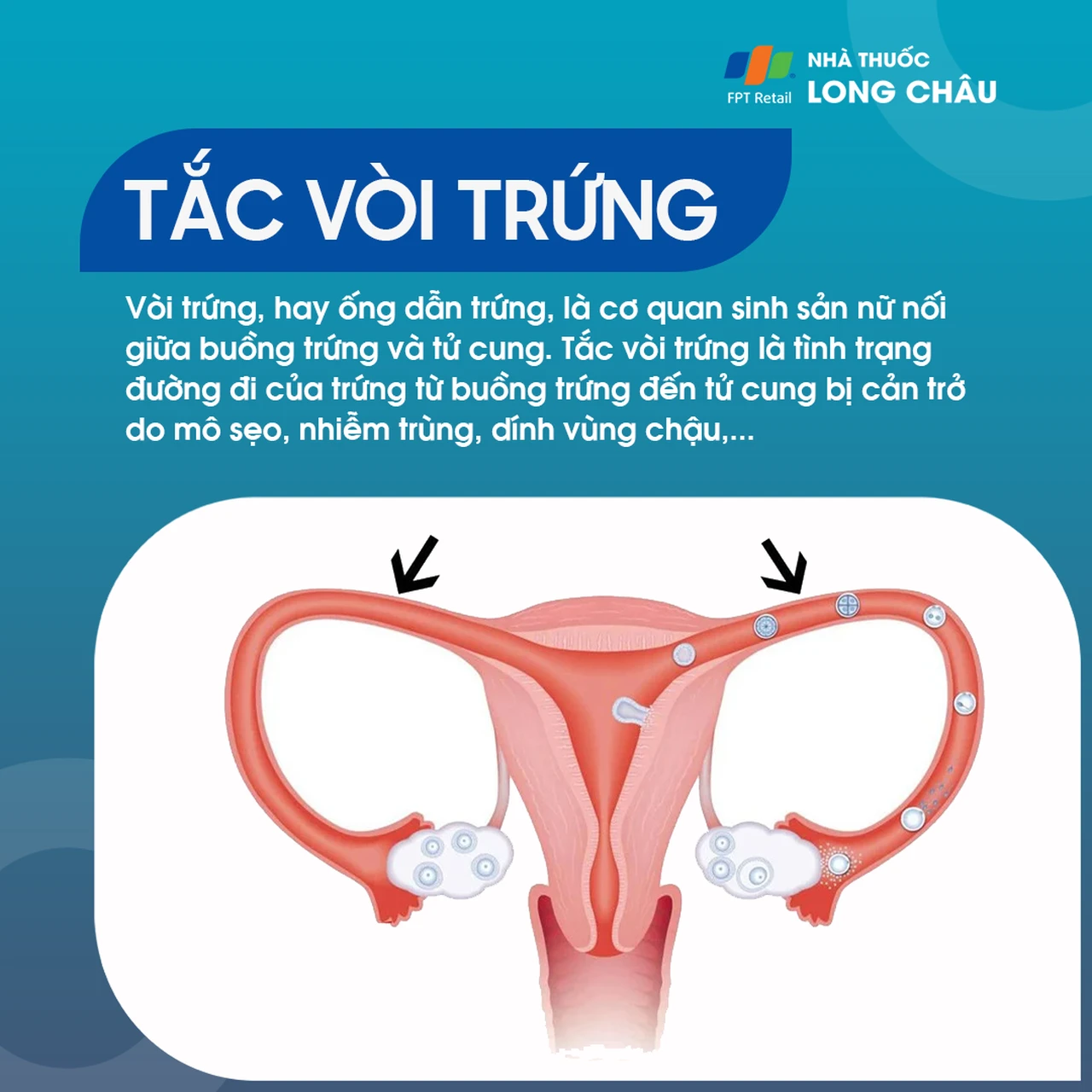 Tắc vòi trứng 1