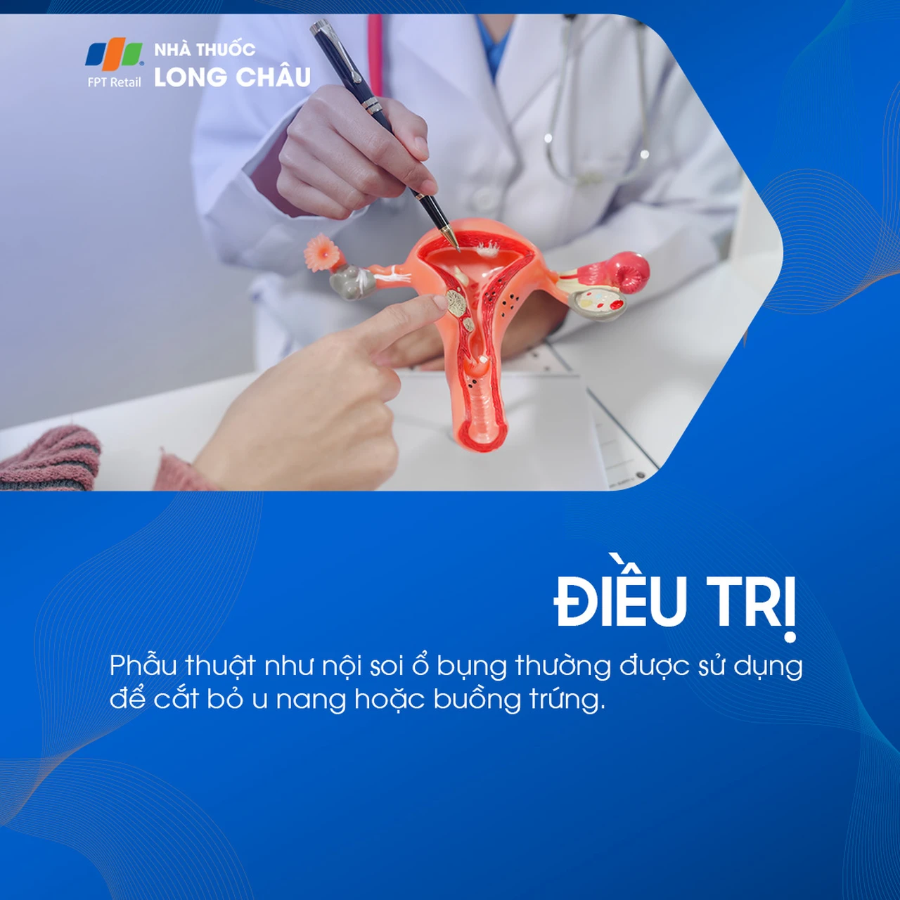 U bì buồng trứng 7