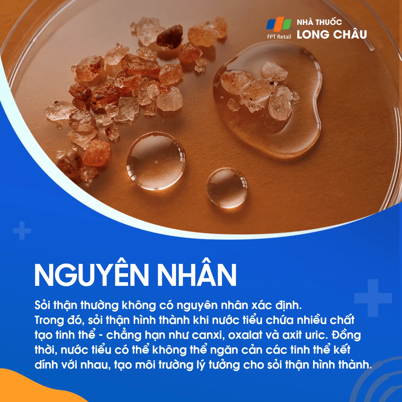 Nguyên nhân sỏi thận - Các yếu tố gây hình thành sỏi 
