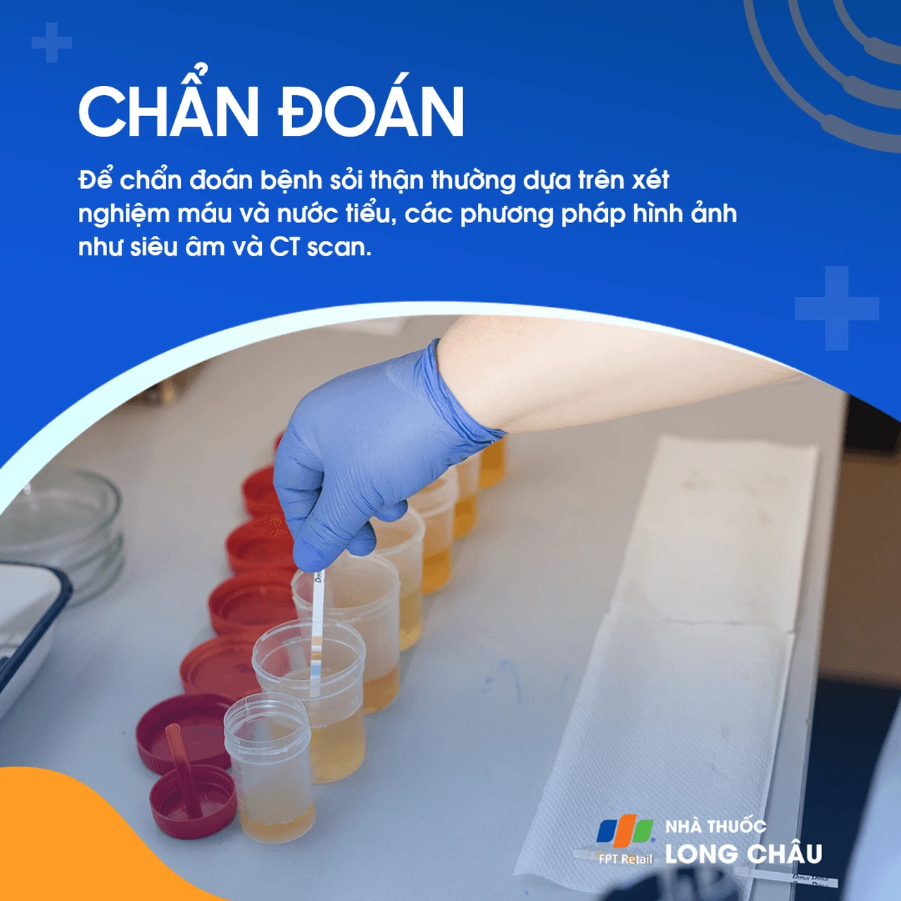 Chẩn đoán sỏi thận - Quy trình kiểm tra và xác định vị trí sỏi thận