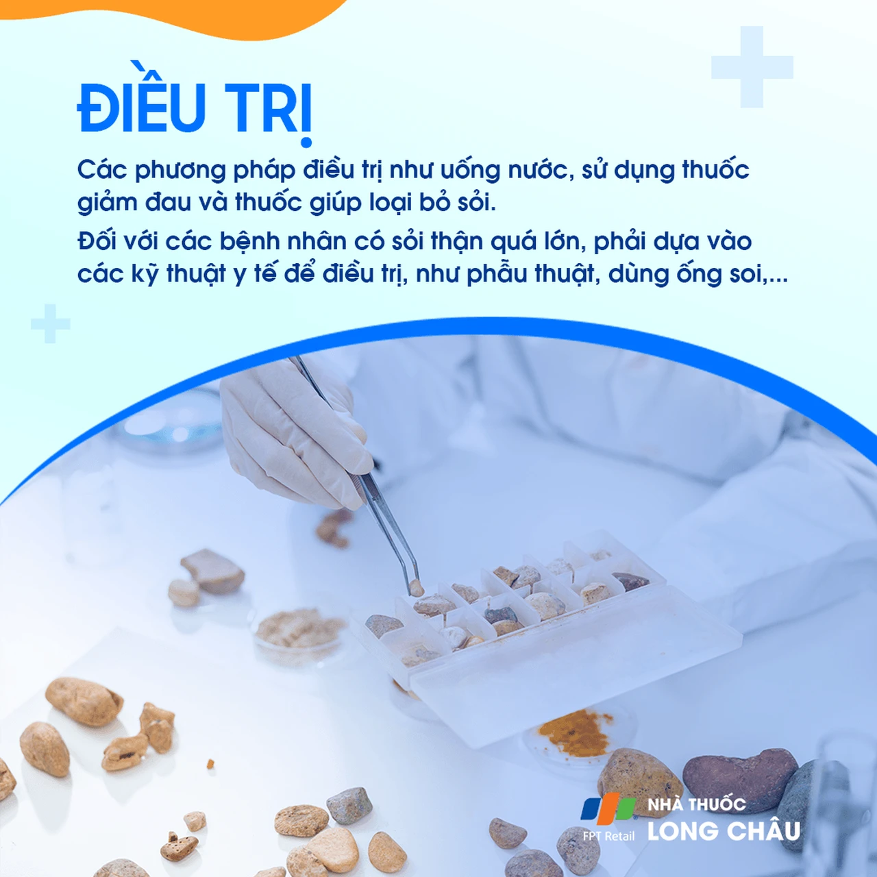 Điều trị sỏi thận - Phương pháp tán sỏi và phẫu thuật loại bỏ sỏi thận