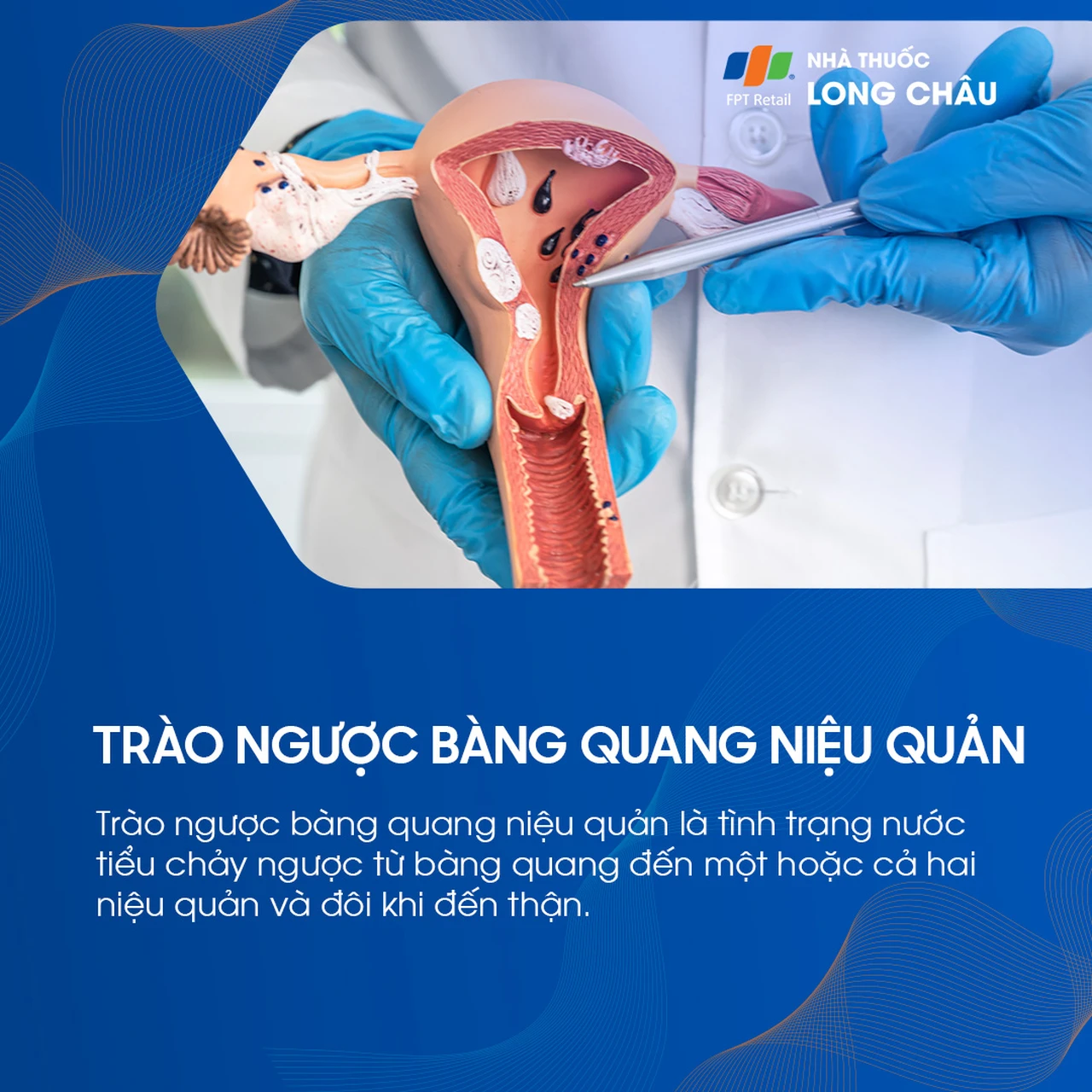 Trào ngược bàng quang niệu quản 1
