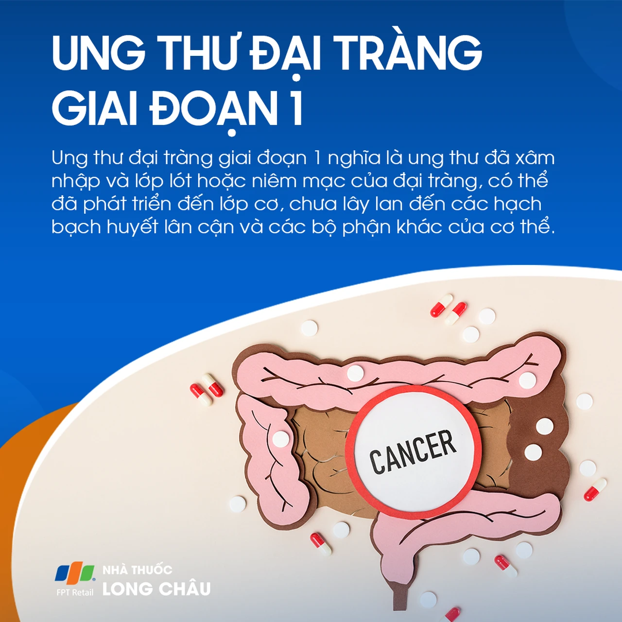 Ung thư đại tràng giai đoạn 2