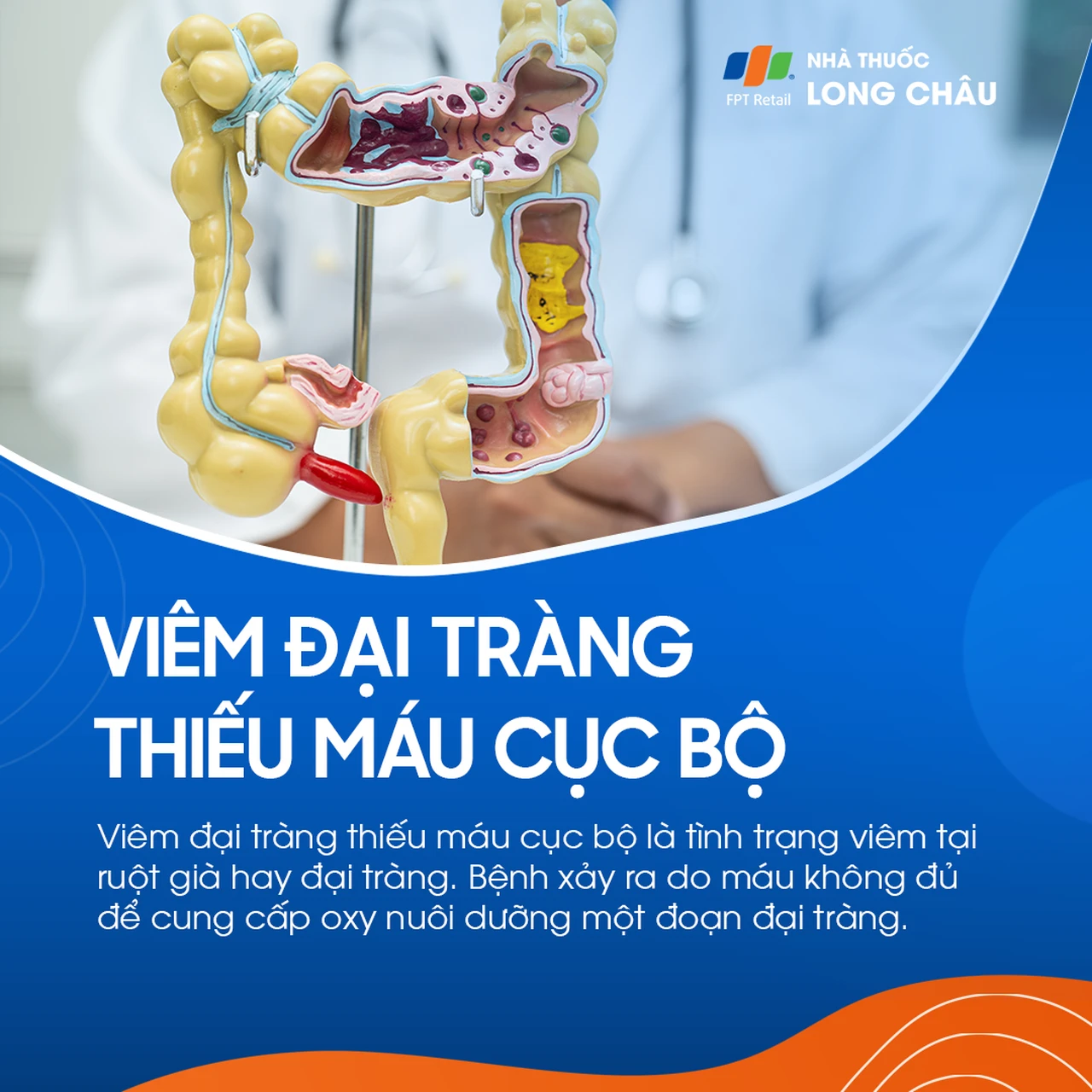 Viêm đại tràng thiếu máu cục bộ 1