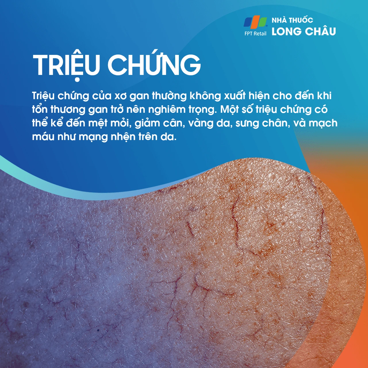 Triệu chứng xơ gan - Dấu hiệu mệt mỏi và vàng da do tổn thương gan mãn tính