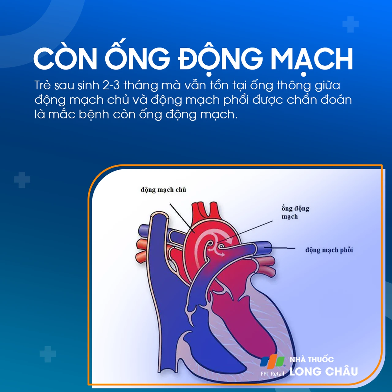Còn ống động mạch 2