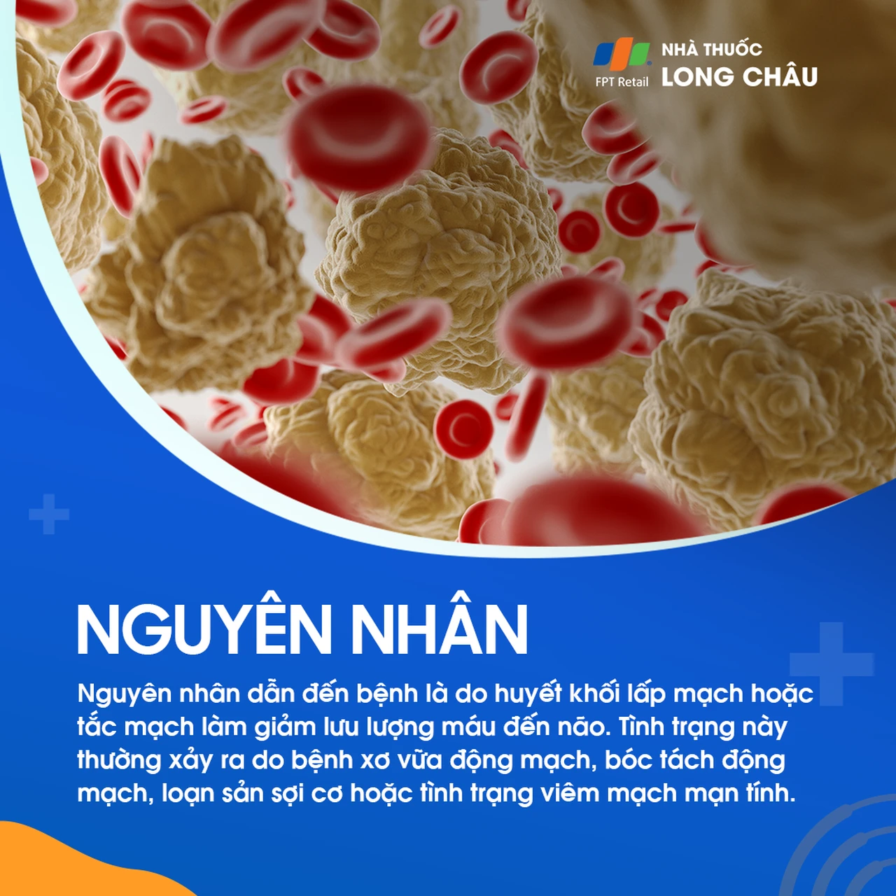 Đột quỵ thiếu máu cục bộ 3