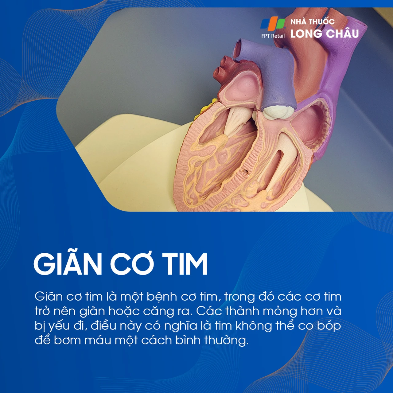 Giãn cơ tim 1
