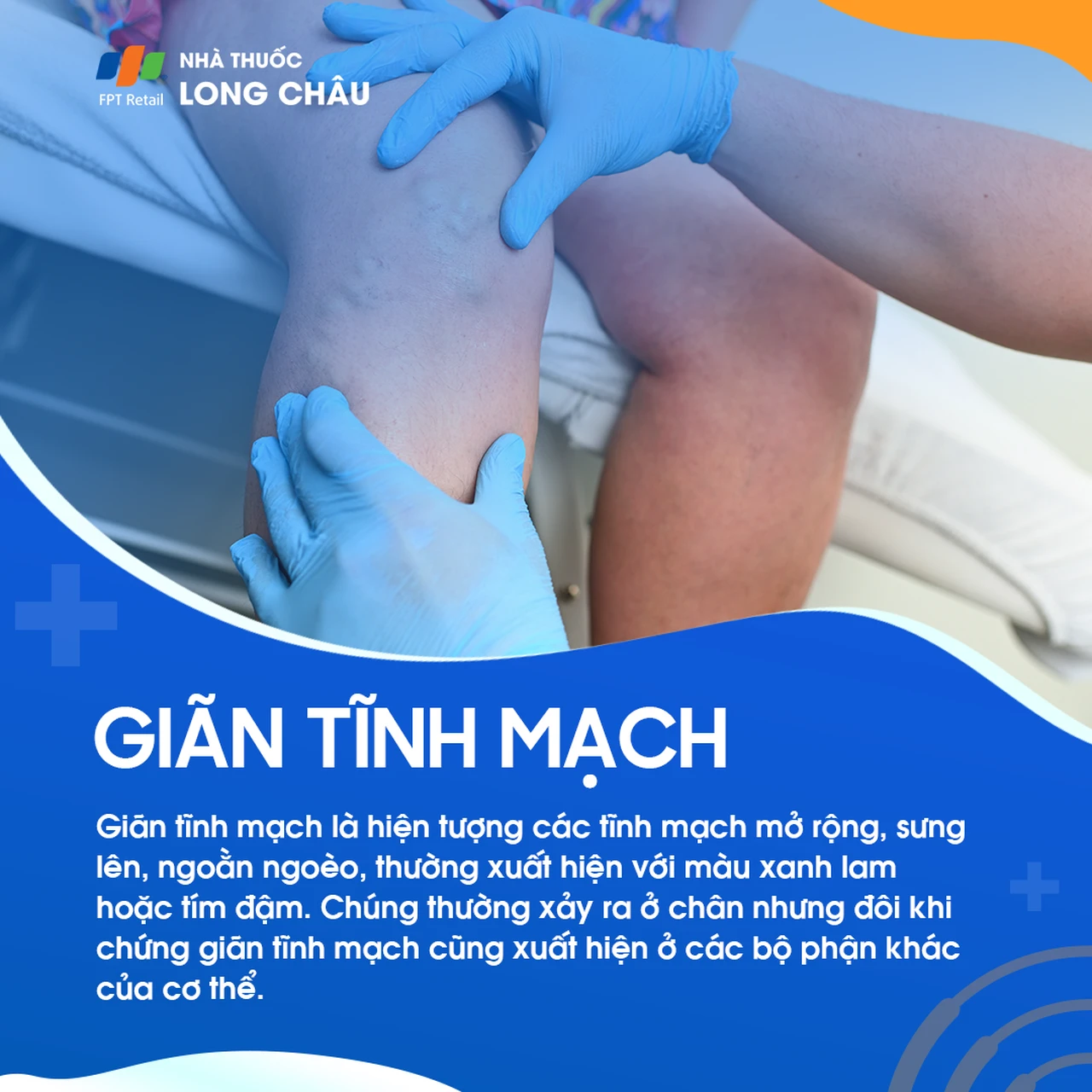 Giãn tĩnh mạch 1