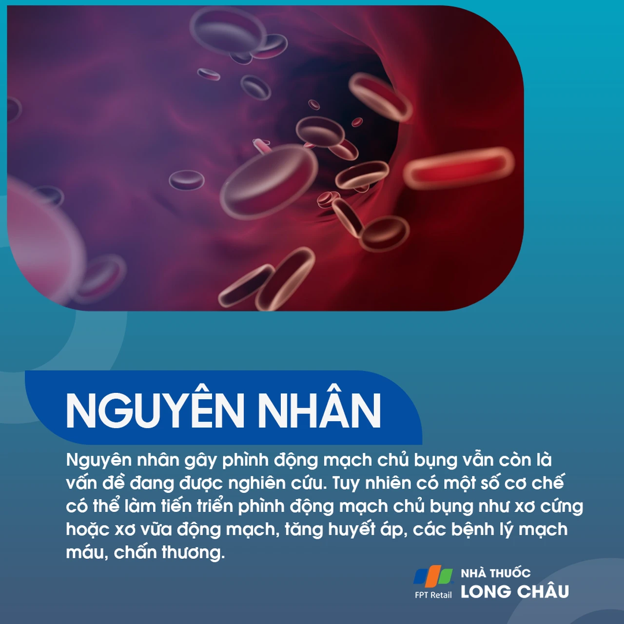 Phình động mạch chủ bụng 3