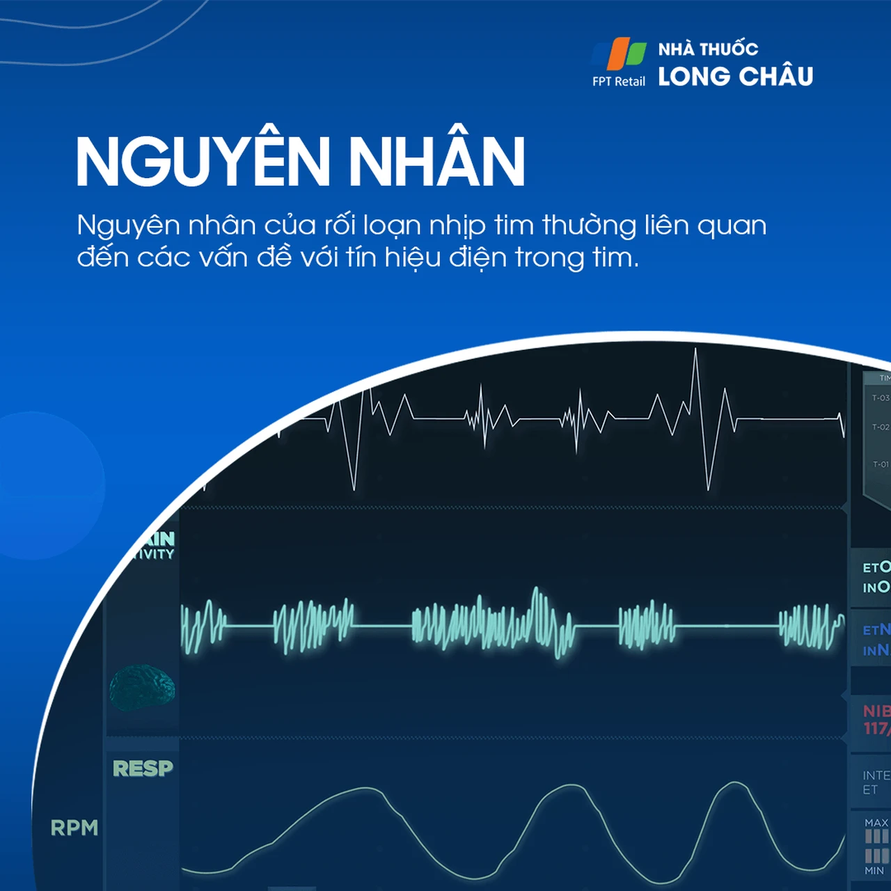 Nguyên nhân rối loạn nhịp tim do bệnh tim mạch, stress và rối loạn điện giải