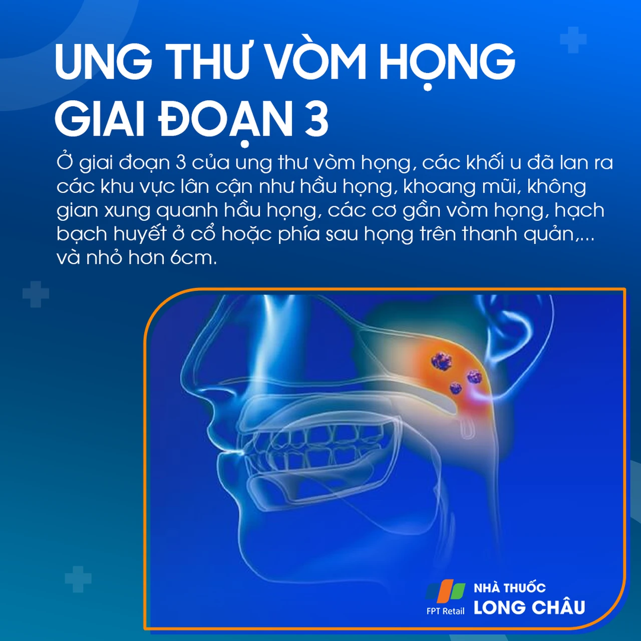 Ung thư vòm họng giai đoạn 3 - 1