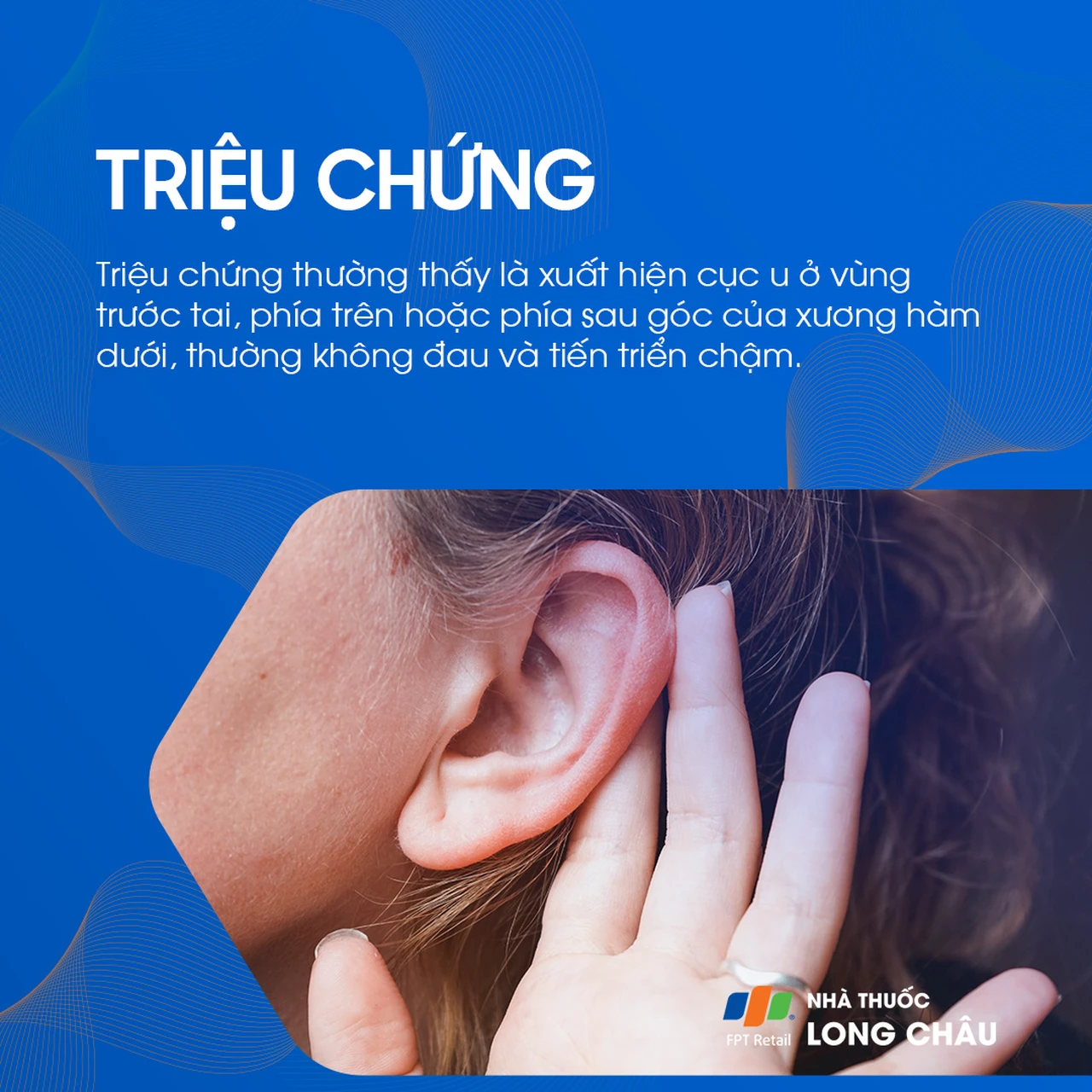 U tuyến nước bọt mang tai 2