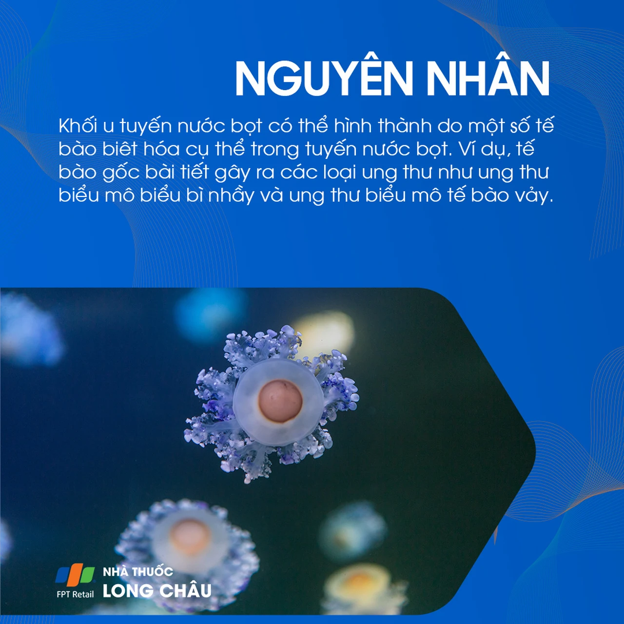 U tuyến nước bọt mang tai 4