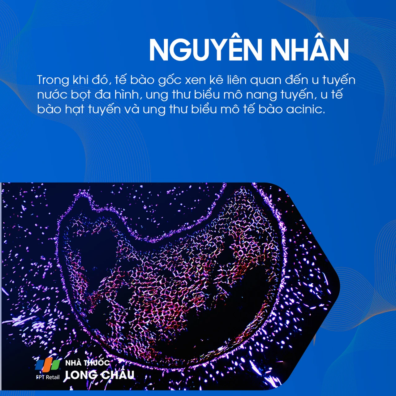 U tuyến nước bọt mang tai 5