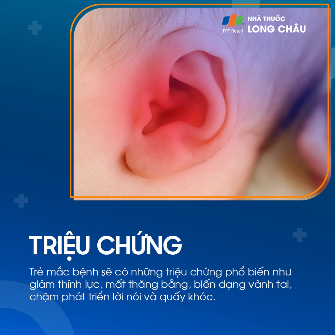 Viêm tai giữa ứ dịch 2