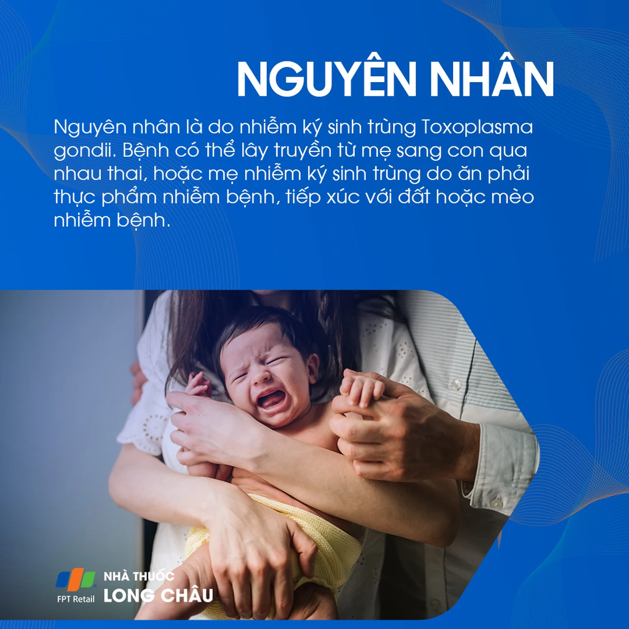 Nhiễm Toxoplasmosis bẩm sinh 3