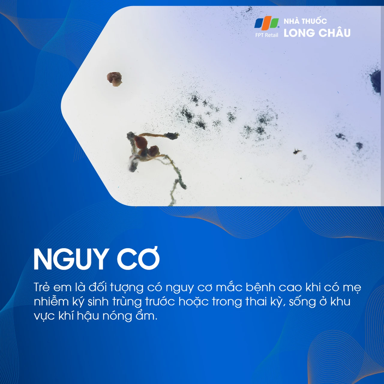 Nhiễm Toxoplasmosis bẩm sinh 4