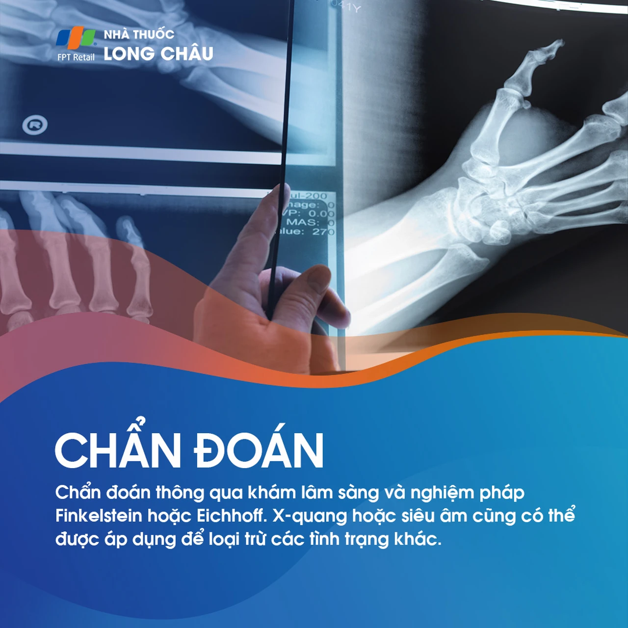 Đau cổ tay sau sinh 5