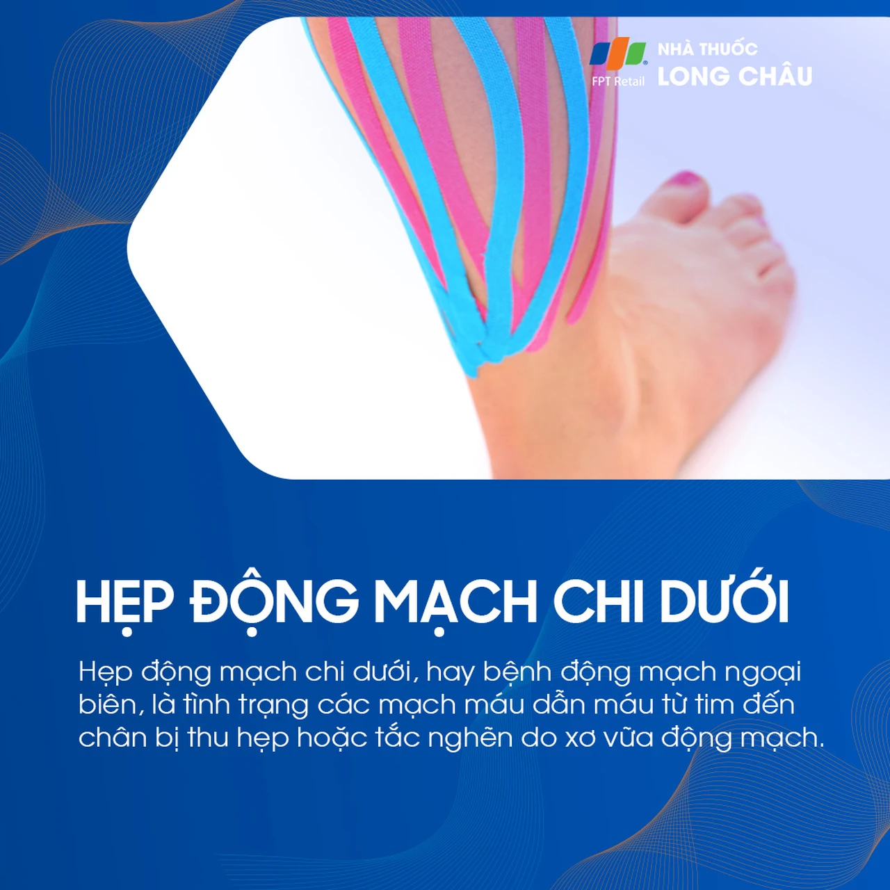 Hẹp động mạch chi dưới 1