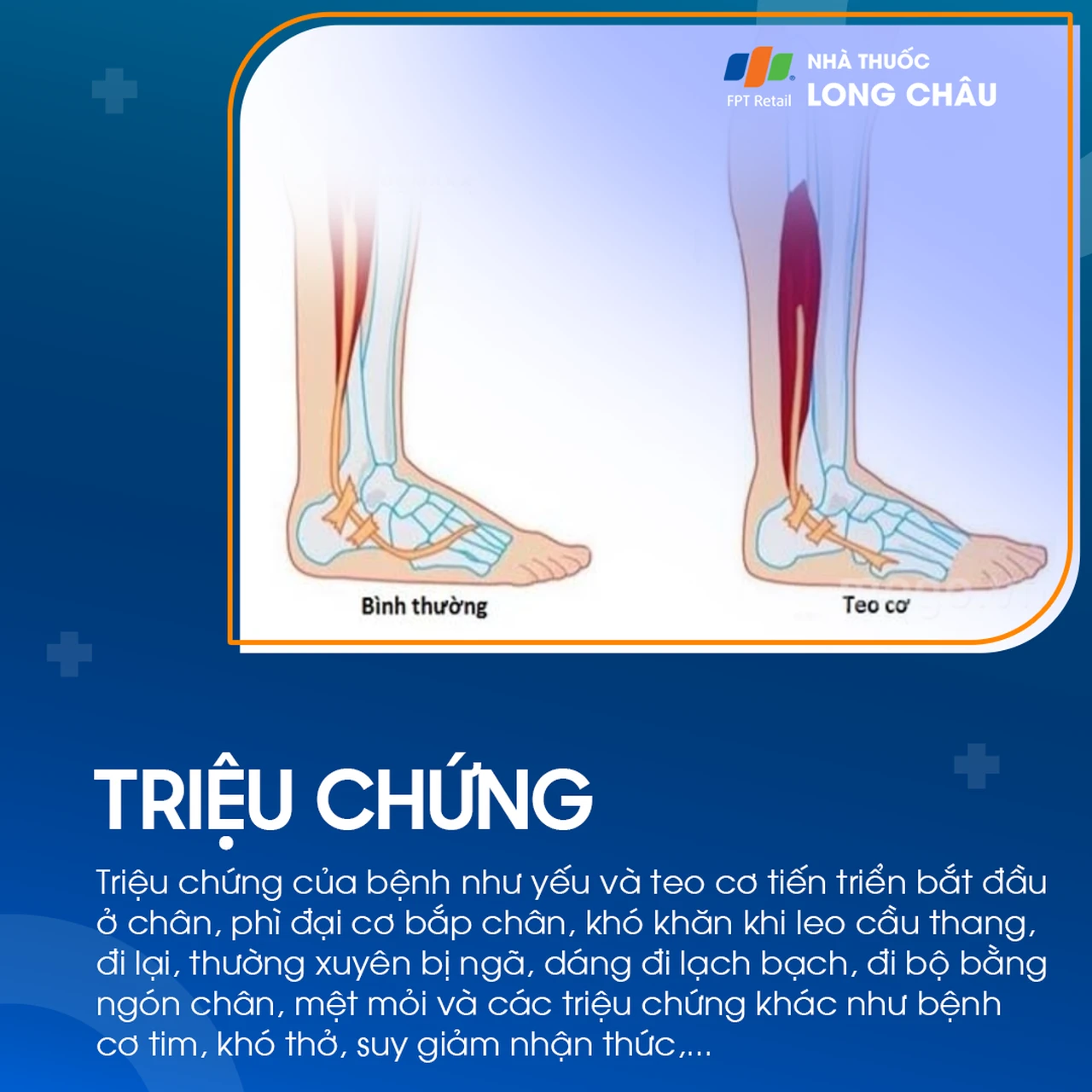 Loạn dưỡng cơ Duchenne 2