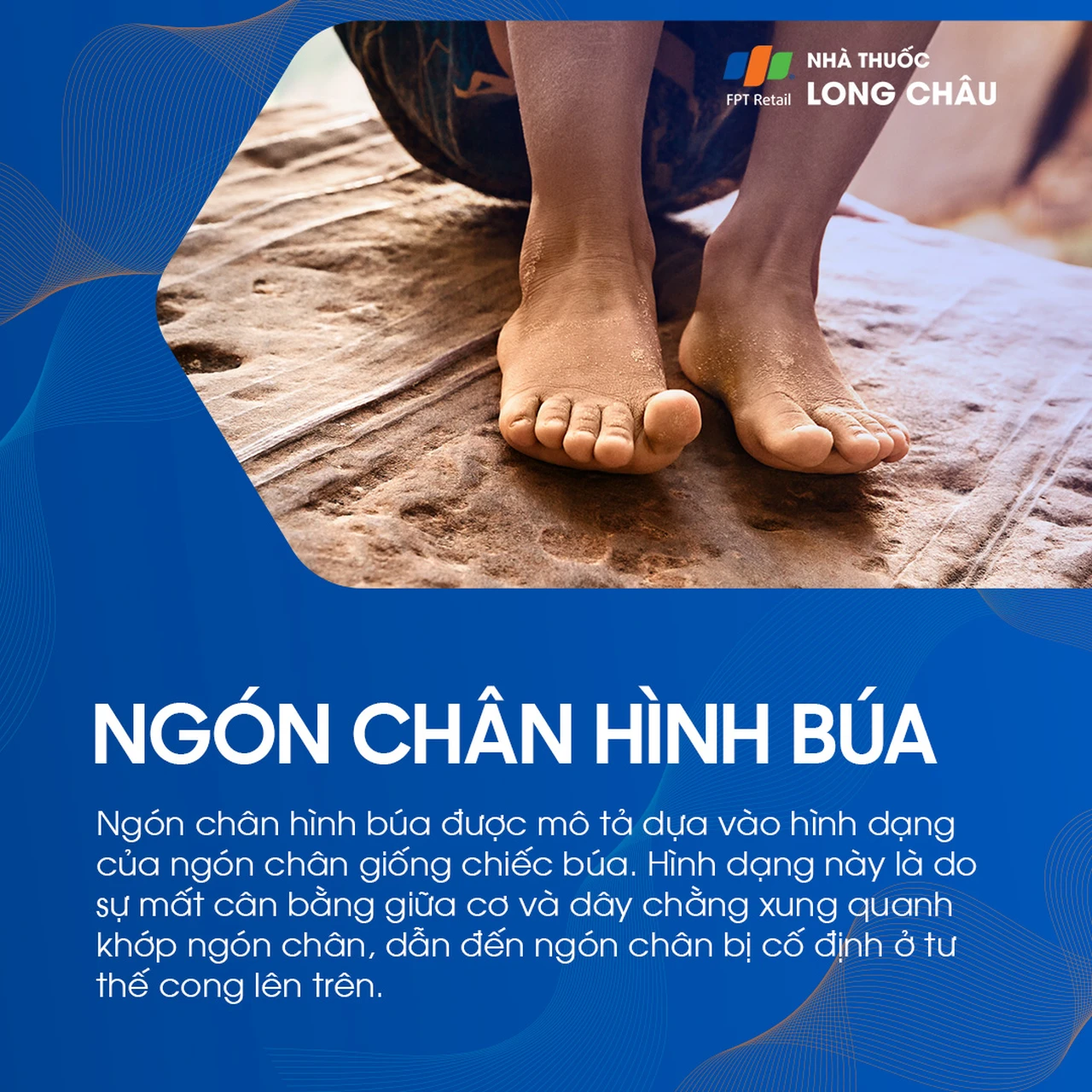 Ngón chân hình búa 1