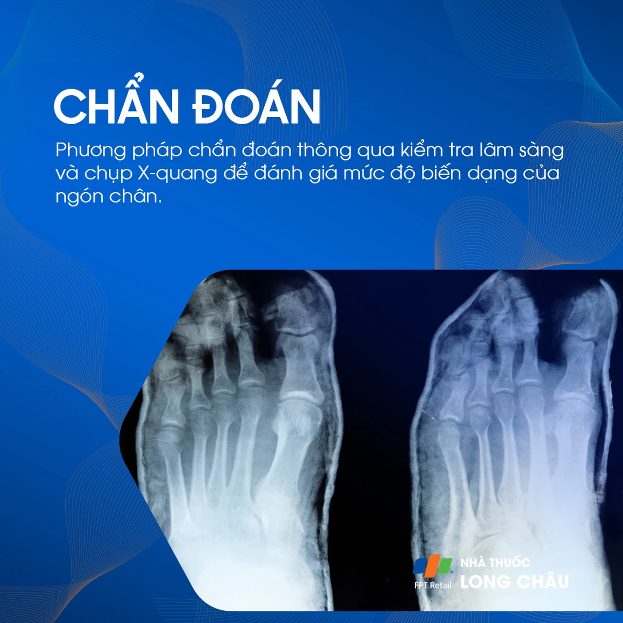 Ngón chân hình búa 5