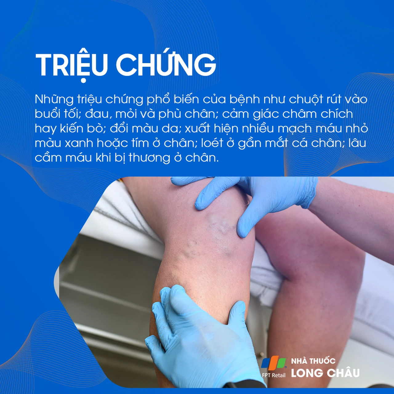 Suy giãn tĩnh mạch chi dưới 2
