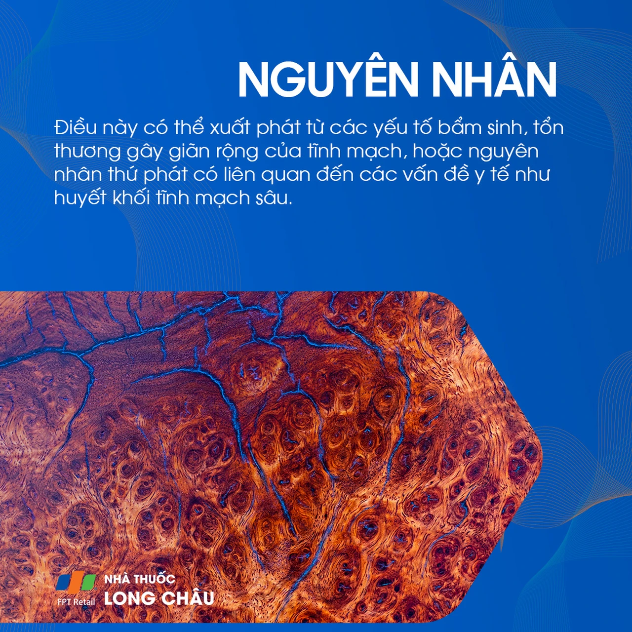 Suy giãn tĩnh mạch chi dưới 4
