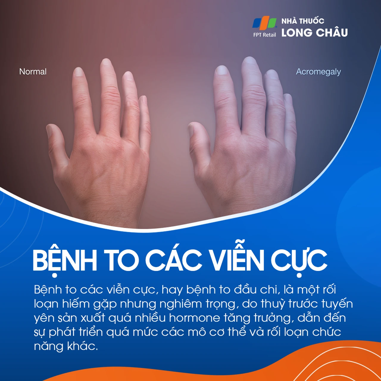 Bệnh to các viễn cực 1