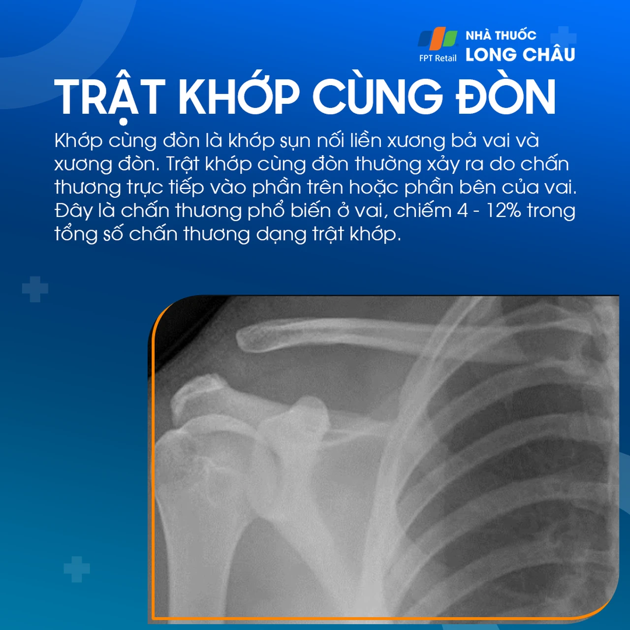 Trật khớp cùng đòn 1