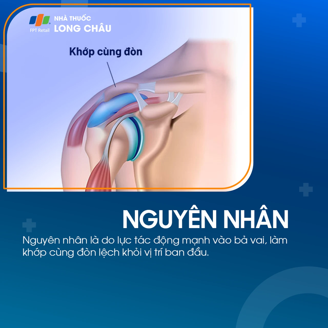 Trật khớp cùng đòn 3