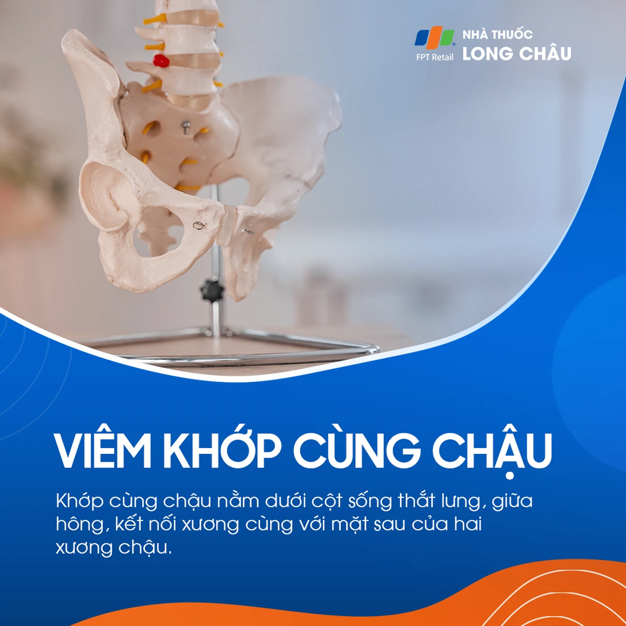 Viêm khớp cùng chậu 1