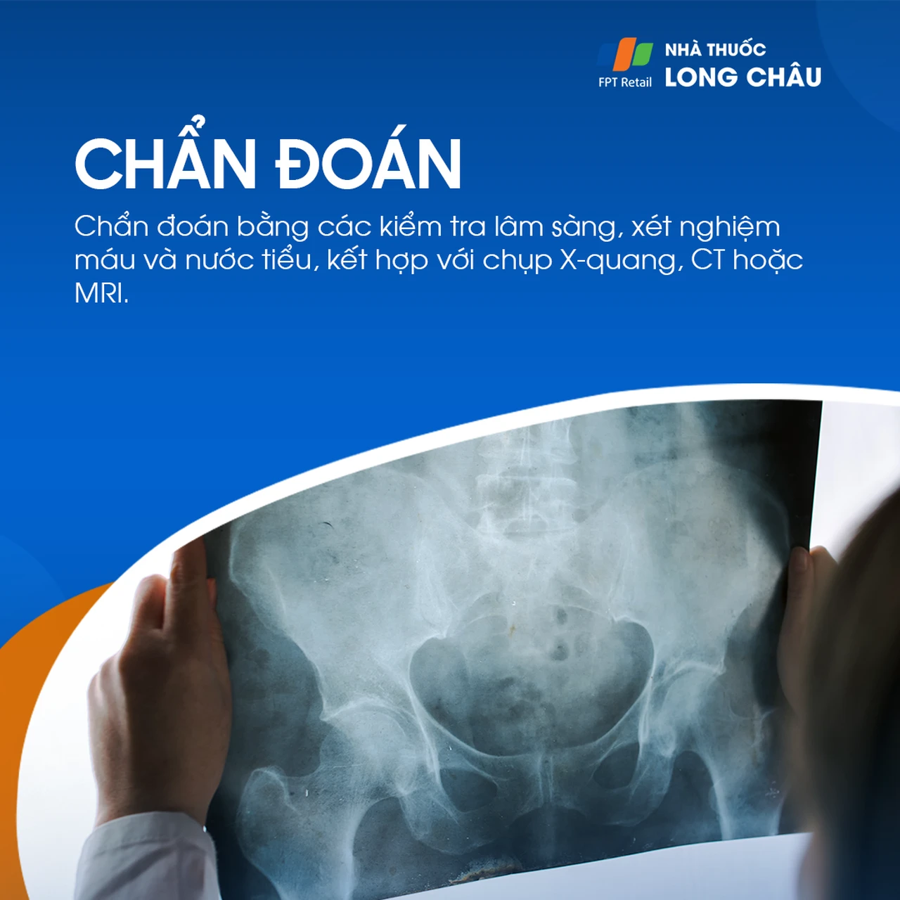 Viêm khớp cùng chậu 6