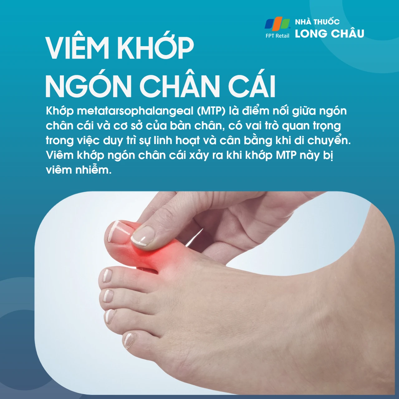 Viêm khớp ngón chân cái 1