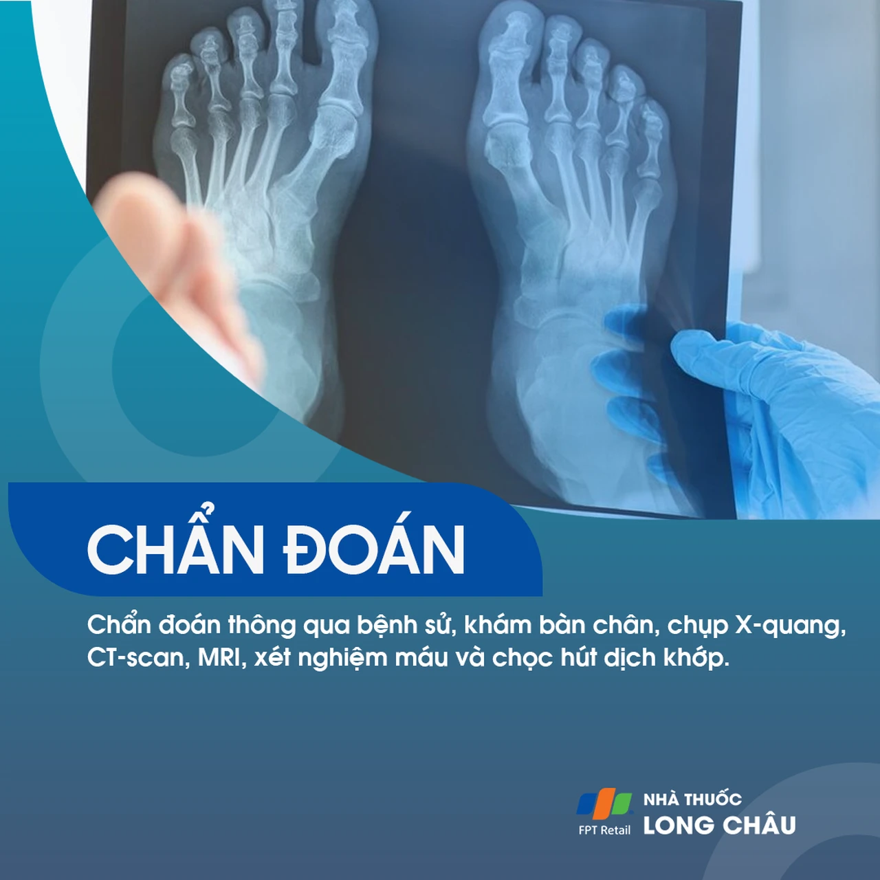 Viêm khớp ngón chân cái 5
