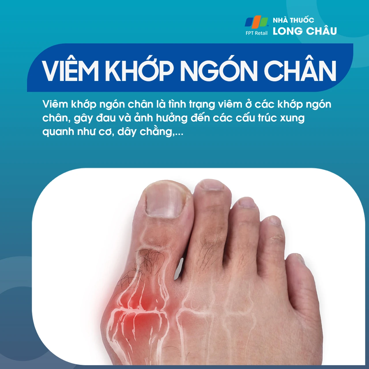 Viêm khớp ngón chân 1