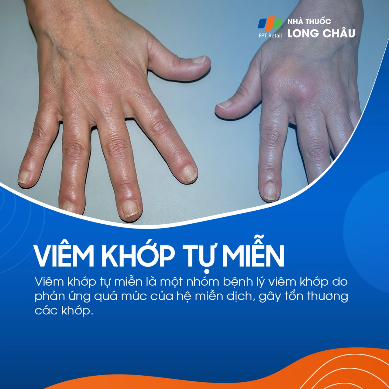 Viêm khớp tự miễn 1