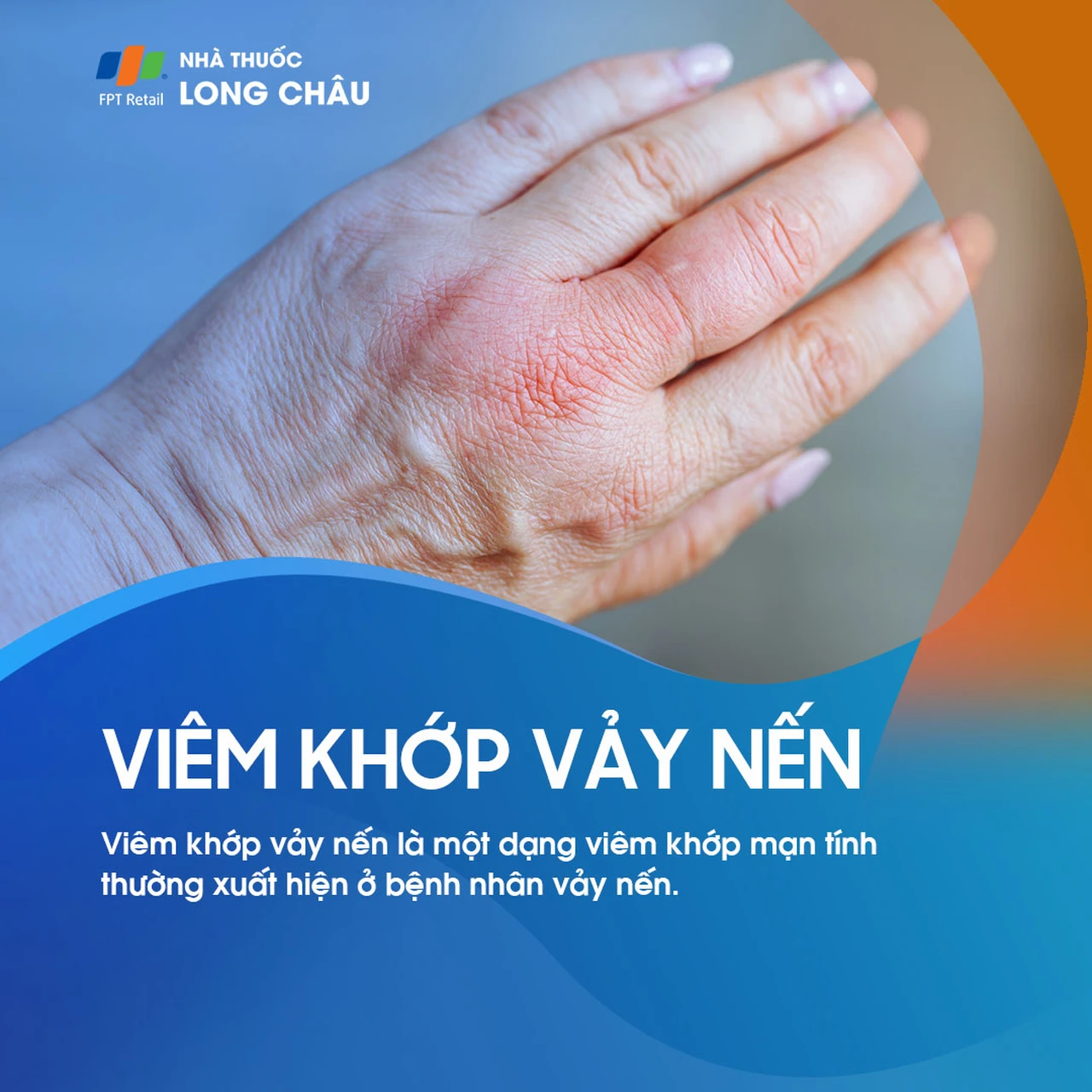 Viêm khớp vảy nến 1