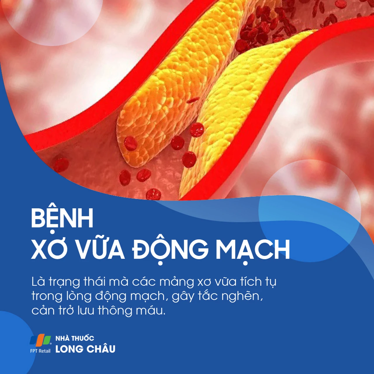 Xơ vữa động mạch 1