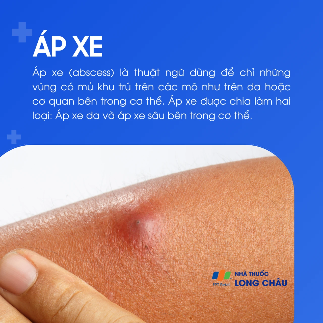 Áp xe là tình trạng tụ mủ khu trú ở mô mềm hoặc cơ quan bên trong cơ thể