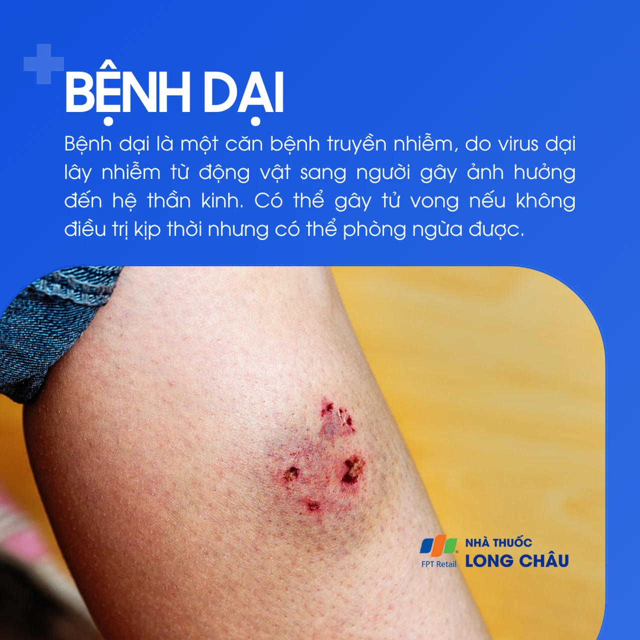 Bệnh dại do virus, lây từ động vật sang người, có thể tử vong nếu không điều trị
