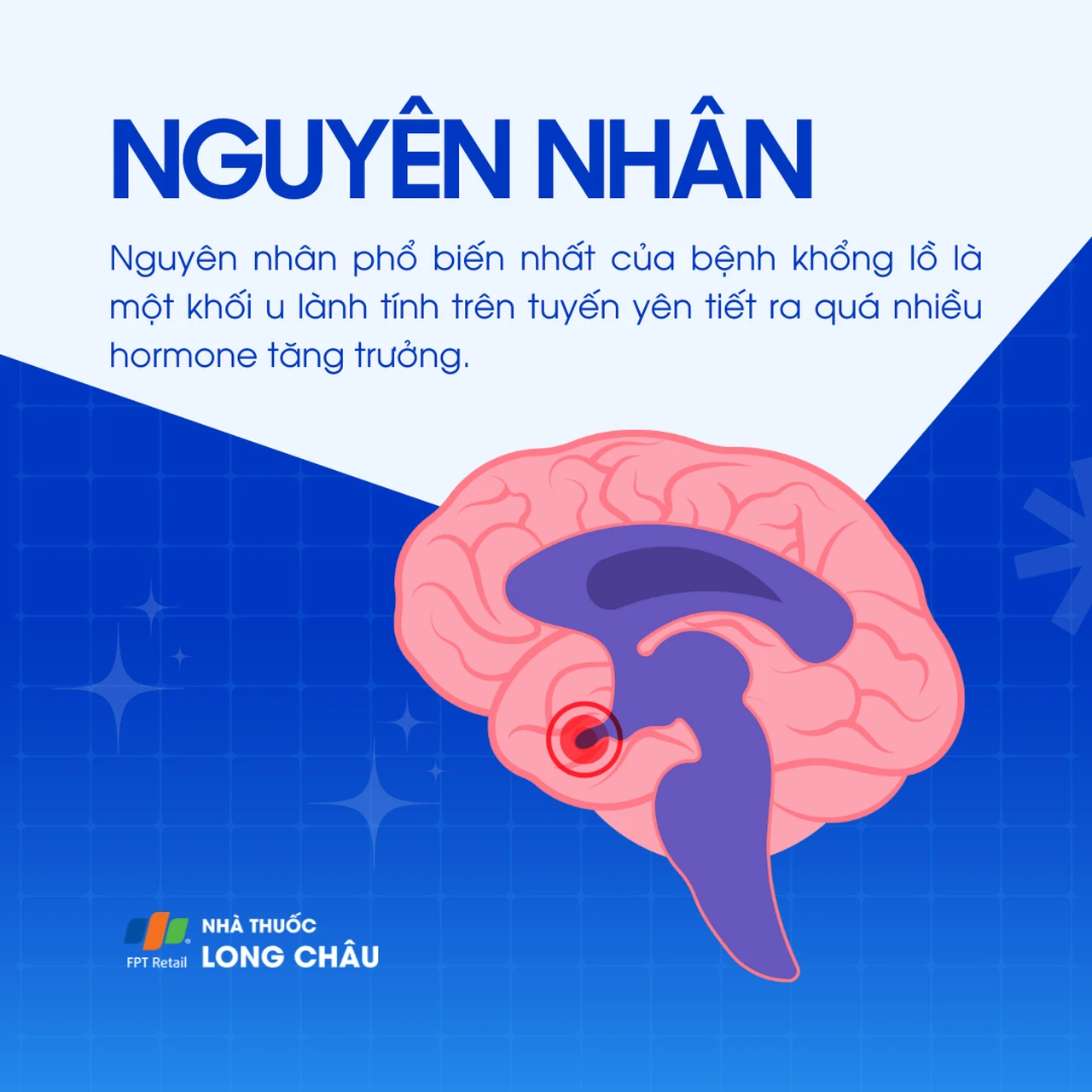 Bệnh khổng lồ 3