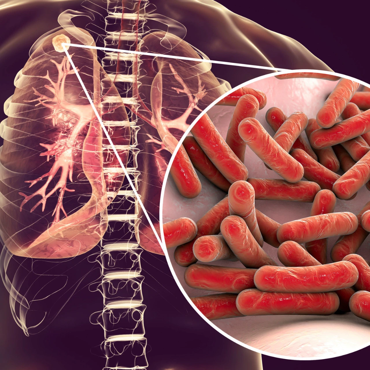 Bệnh lao là gì? Những vấn đề cần biết về bệnh lao 1