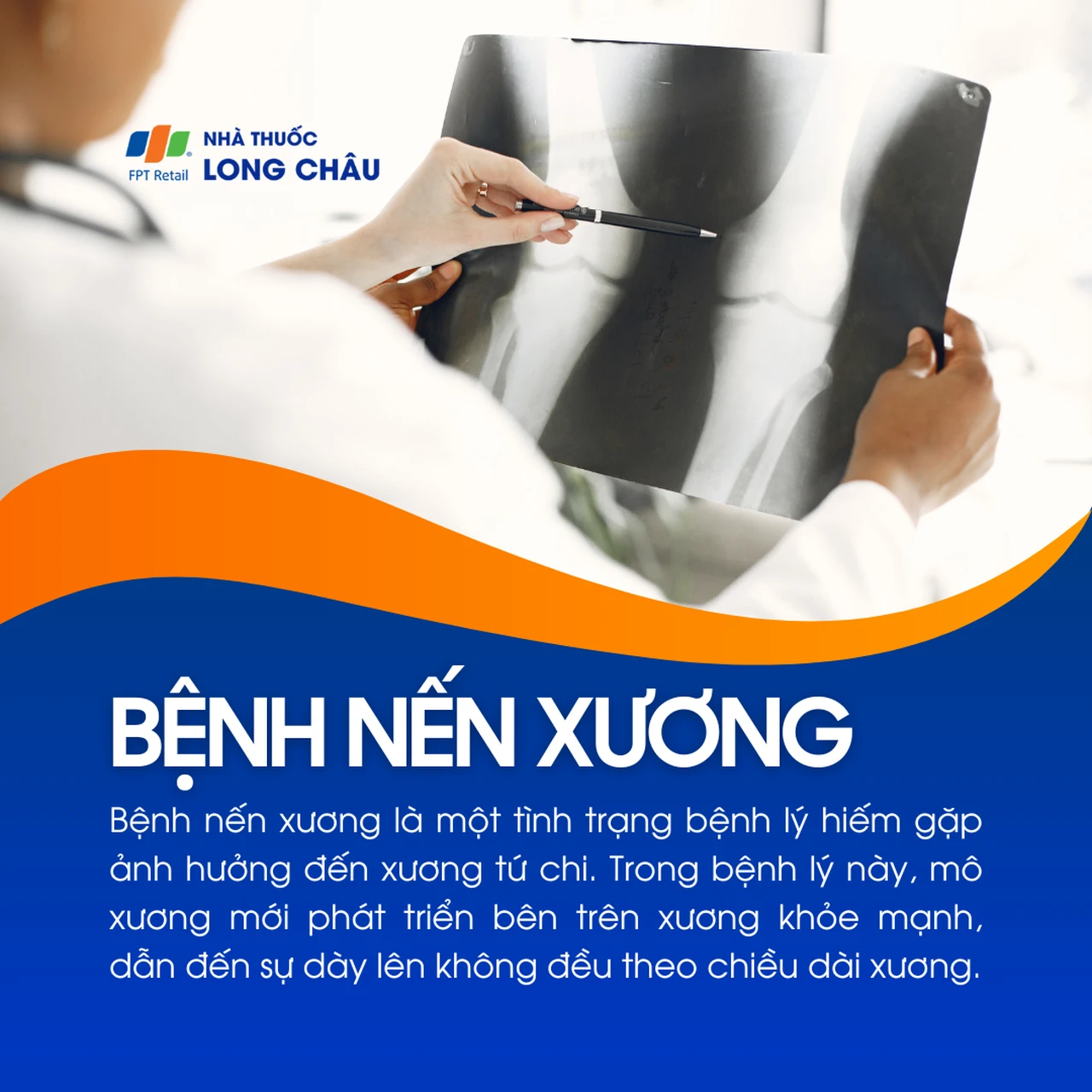Bệnh nến xương 1
