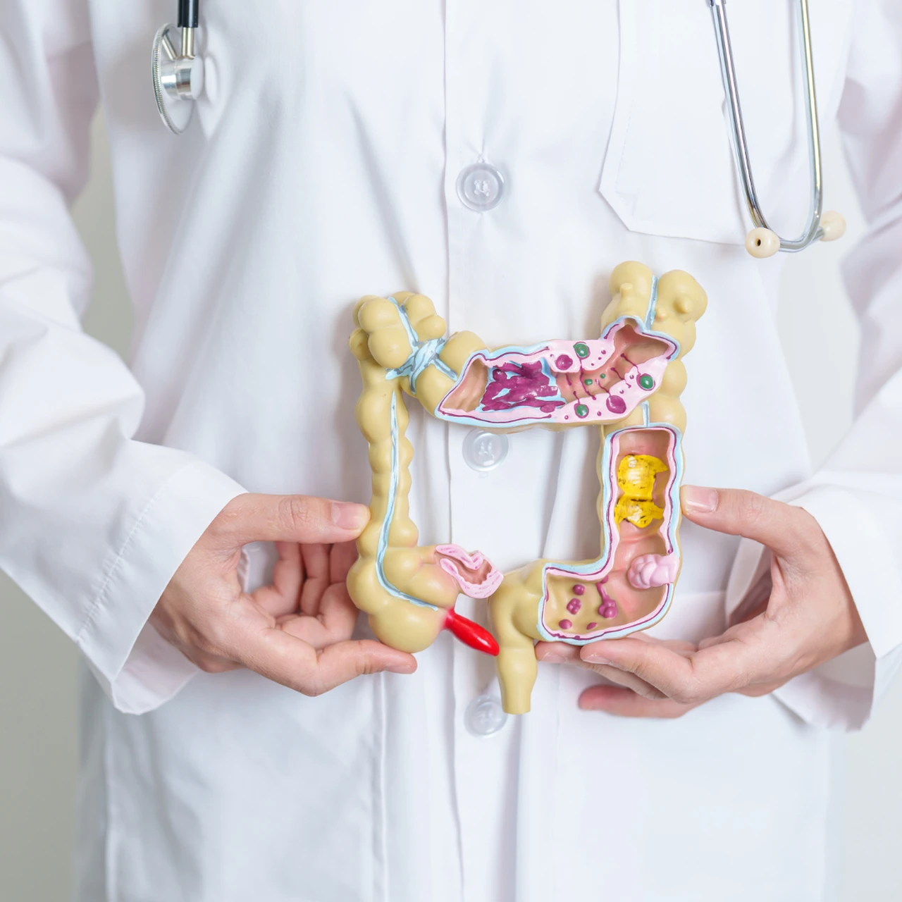 Bệnh viêm ruột IBD là gì? Những vấn đề cần biết về bệnh viêm ruột IBD 2